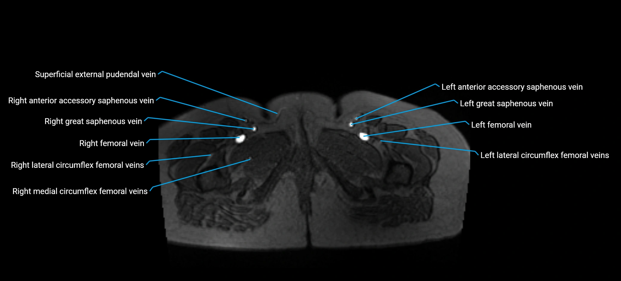 MRV abdomen pelvis & lower limb axial cross sectional anatomy labelled MRI image 204 (1).webp